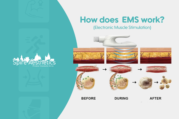 EMS treatment for post pregnancy weight loss treatment Walton on the Hill