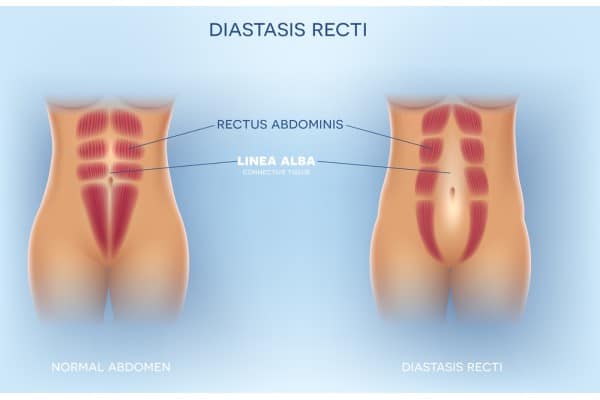 How Does Non-Surgical Treatment Help With Loose Skin, Weak Abdominal Muscles and Post-Pregnancy Changes Walton on the Hill?