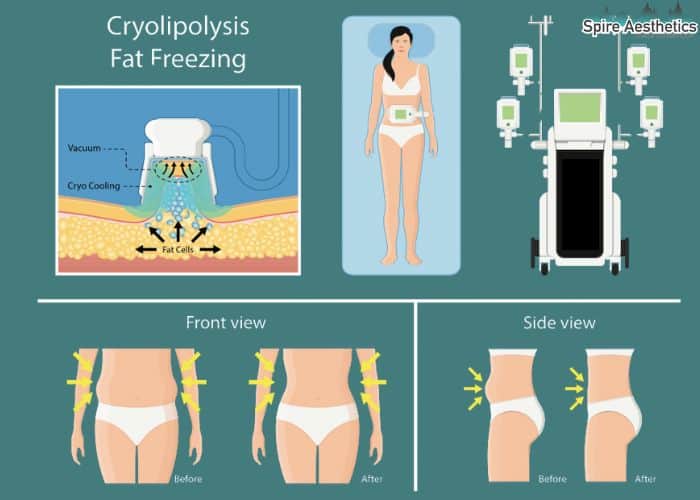Image of diet and fat freezing combined for best results for Spire Aesthetics Walton on the Hill