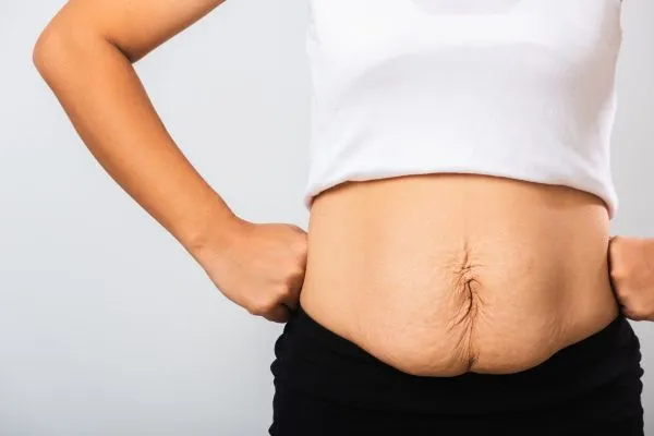 Image of a woman's stomach after weight loss with sagging skin following a gastric band Walton on the Hill