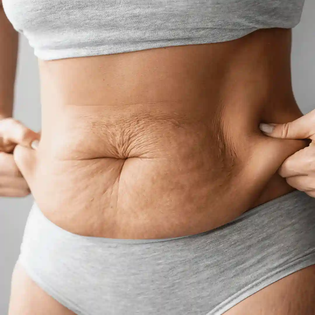Is It Normal to Have Loose Skin After Pregnancy Walton on the Hill?