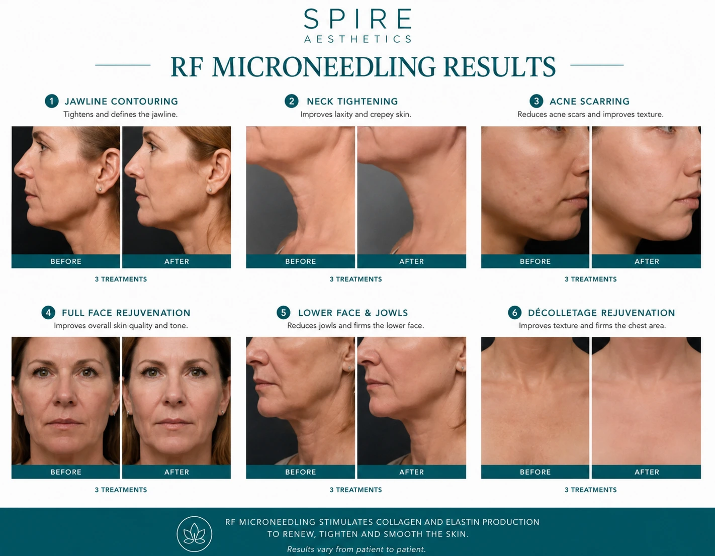 RF Microneedling Skin tightening Walton on the Hill results