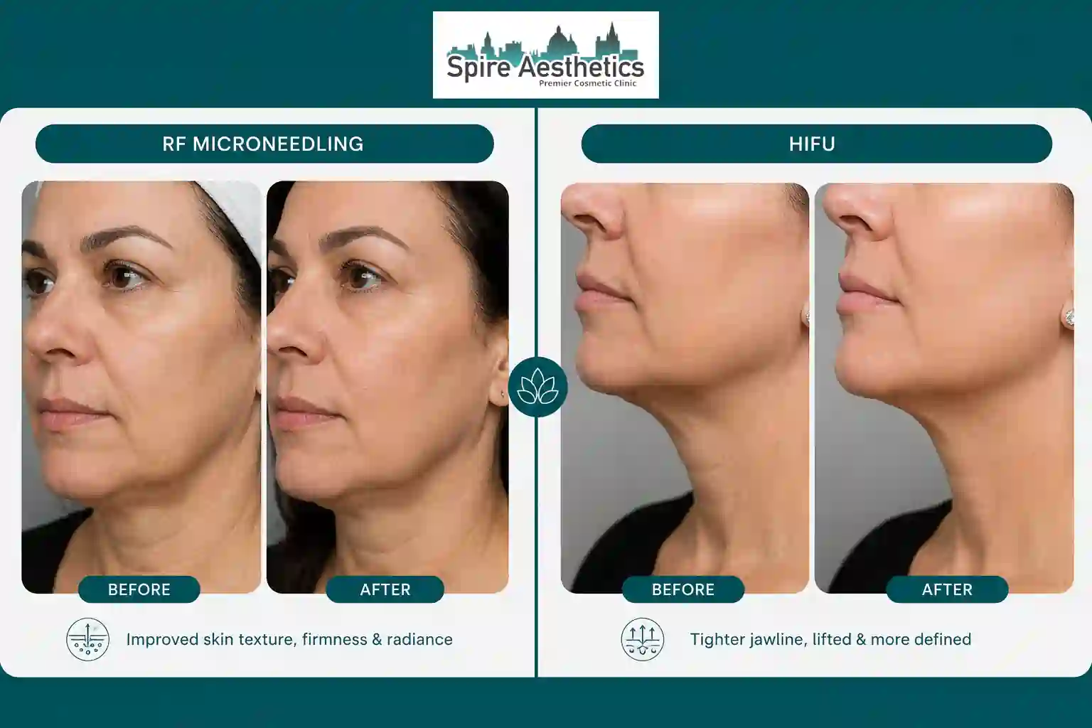 Can RF Microneedling and HIFU Be Combined Walton on the Hill?