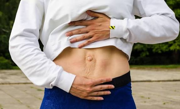 When Could Diastasis Recti Be the Missing Piece of the Puzzle Walton on the Hill?